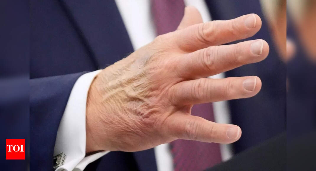 ‘Two-tone hands’ and late arrival respark Trump health chatter as Oval Office gossip swirls ‘Two-tone hands’ and late arrival respark Trump health chatter as Oval Office gossip swirls