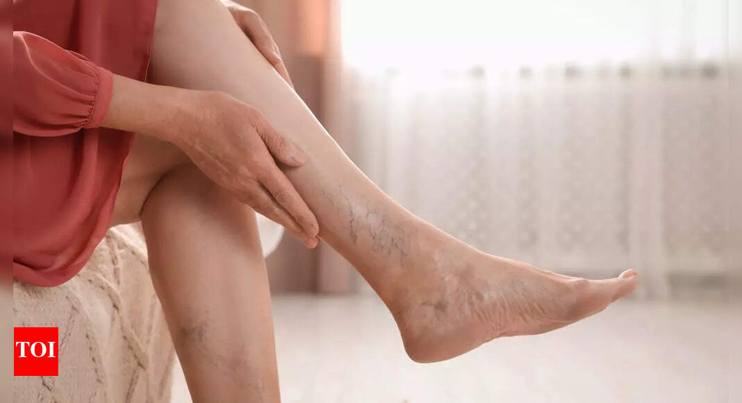 How to get rid of varicose veins naturally: Experts explain causes