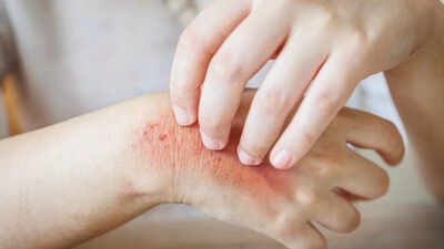  10 skin problems caused by diabetes you should know about