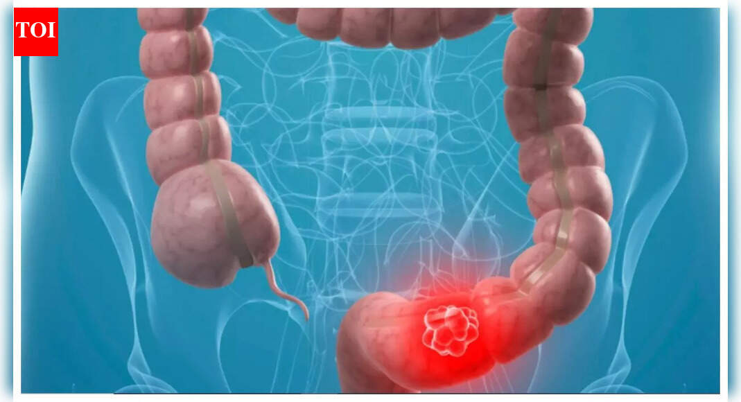 Why is Colon Cancer becoming common in youngsters? 5 risk factors that ...