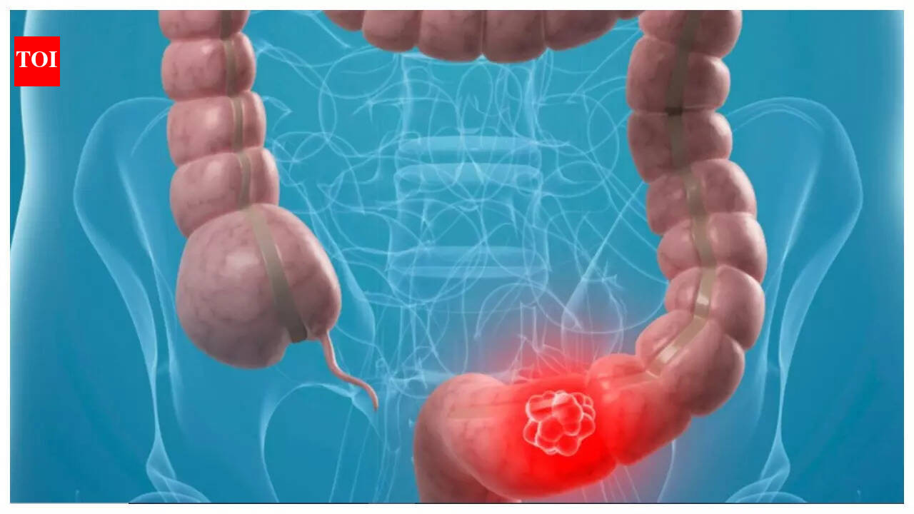 Why is Colon Cancer becoming common in youngsters? 5 risk factors that ...