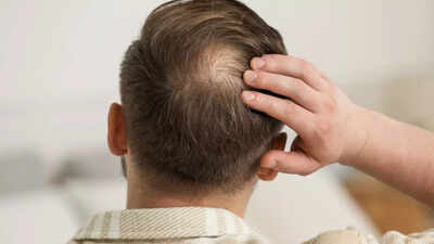 Say goodbye to bald spots: New drug pp405 could regrow your hair naturally