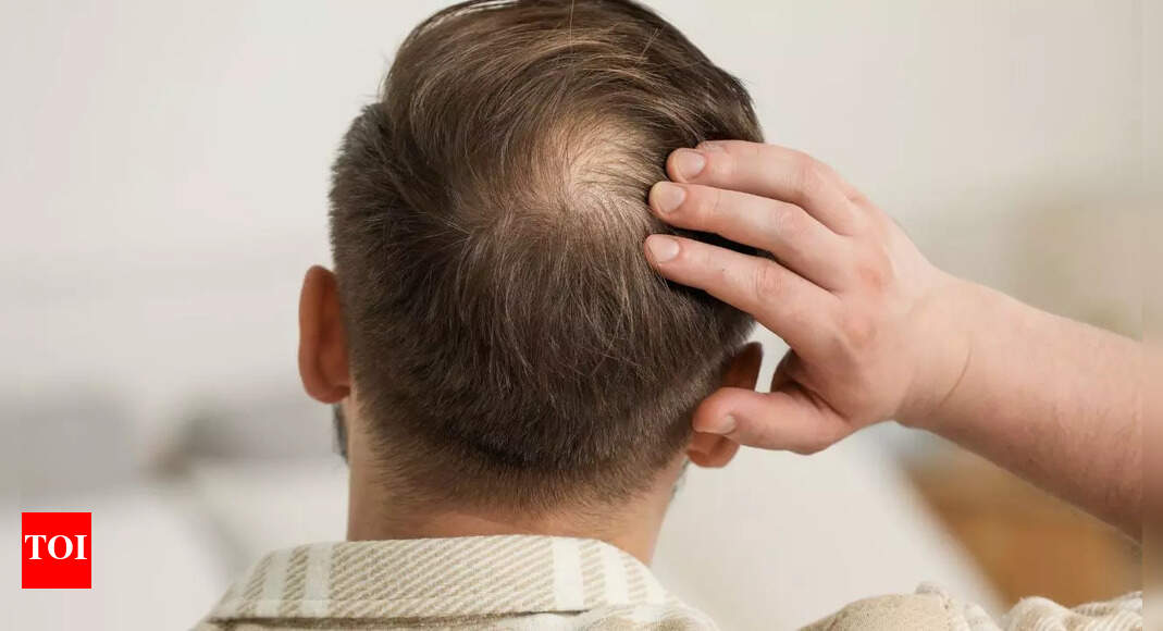 Say goodbye to bald spots: New drug pp405 could regrow your hair naturally |