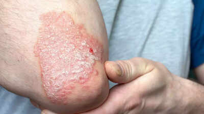 6 ways an anti-inflammatory diet can help manage psoriasis and reduce flare-ups