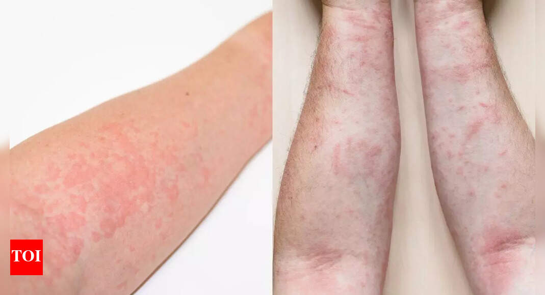 Hives vs rashes: Spot the signs, understand causes, and tips to manage effectively