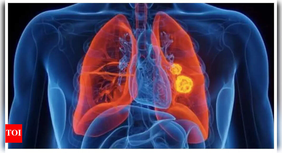Lung Cancer Symptoms: Lung Cancer rising in young adults – causes, symptoms, and prevention | – The Times of India