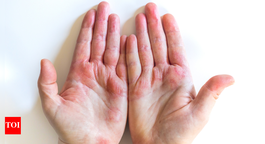 Hand, foot, and mouth disease spreads across Delhi-Haryana: 5 early symptoms to identify in children and precautions to take