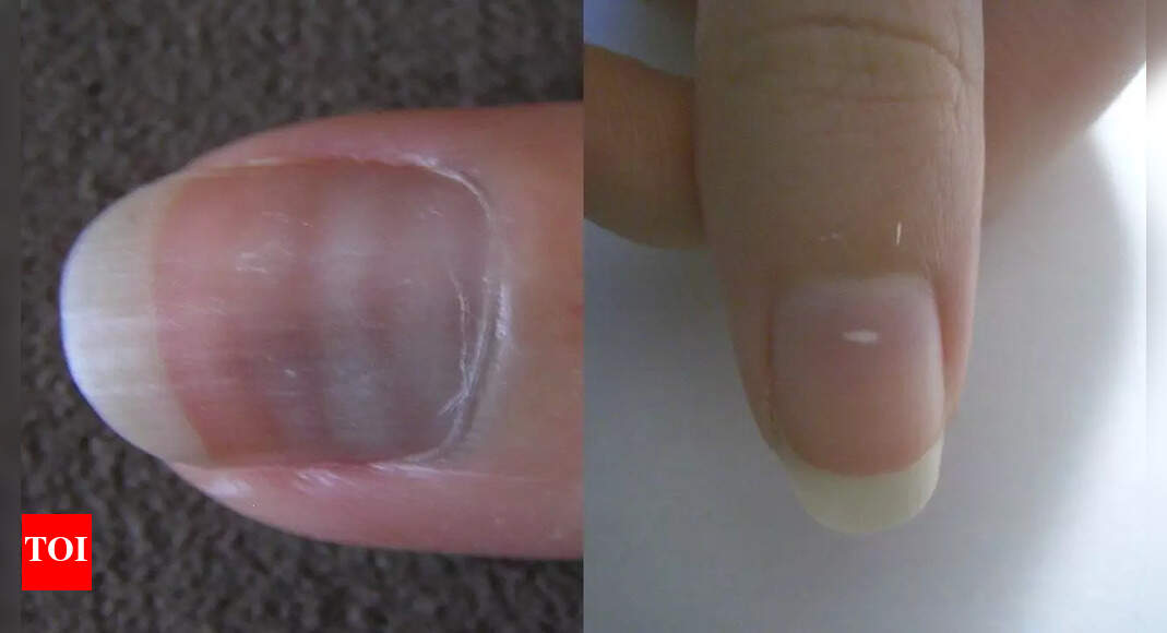 White lines on nails could signal liver, kidney, or heart problems: Know the types