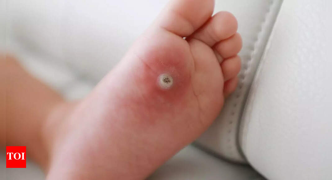 8 natural ways to get rid of foot corns at home safely