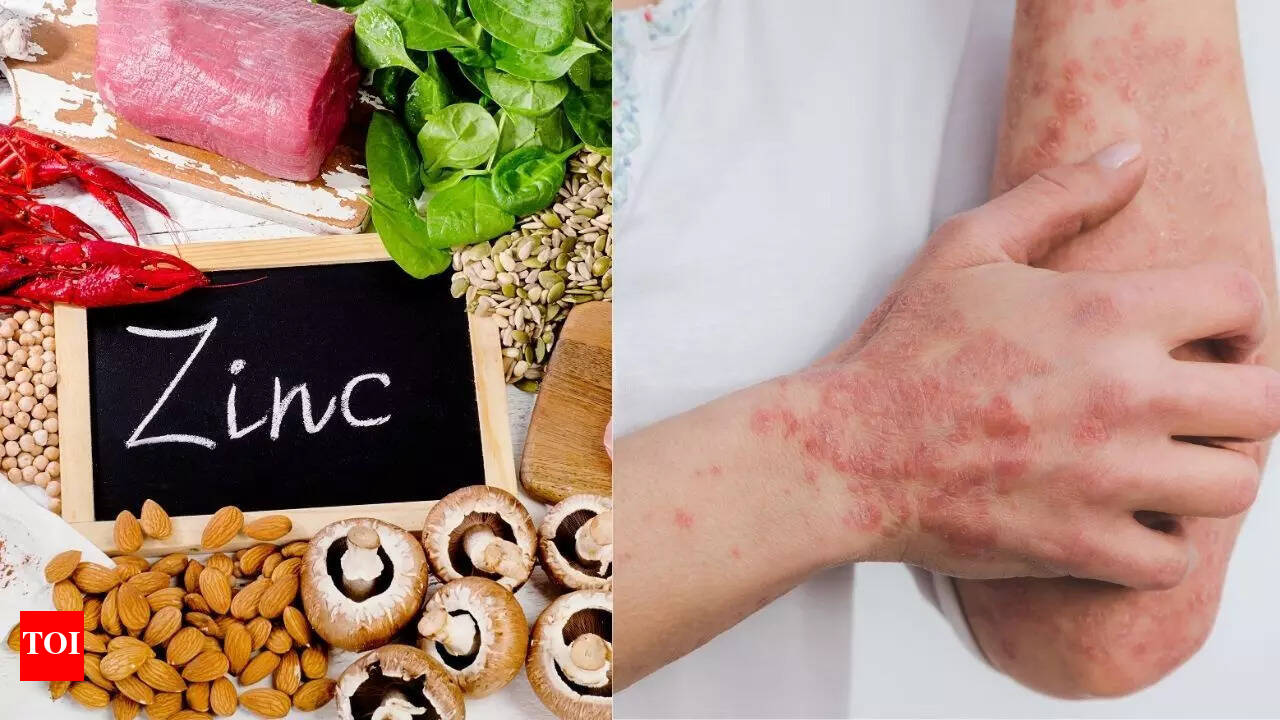 Zinc Deficiency Rashes