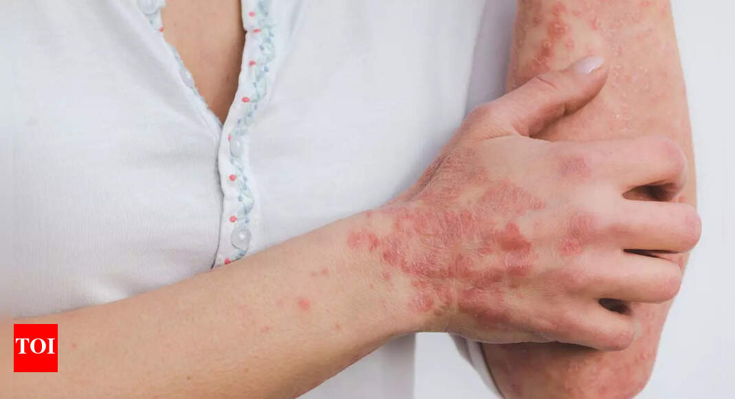20 years of wrong diagnosis as ‘depression and hypochondria’ ends with shocking illness: Frédéric Roscop’s chronic Lyme disease early symptoms overlooked
