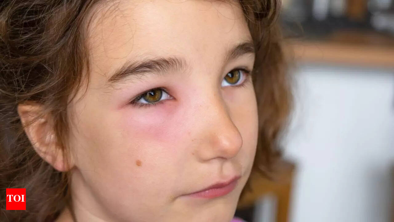 Periorbital Edema Symptoms