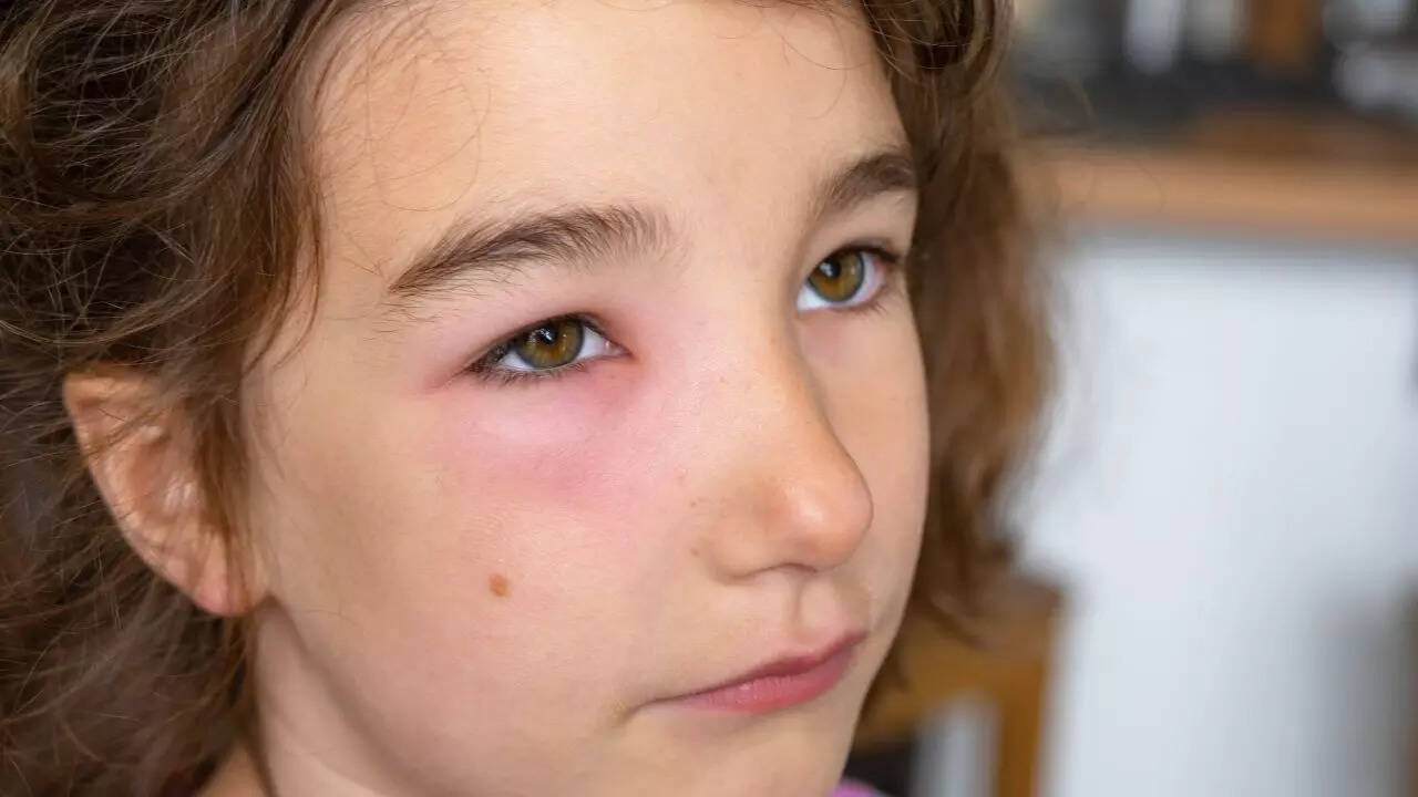 Why Do I Wake Up With Puffy Red Eyes - Infoupdate.org