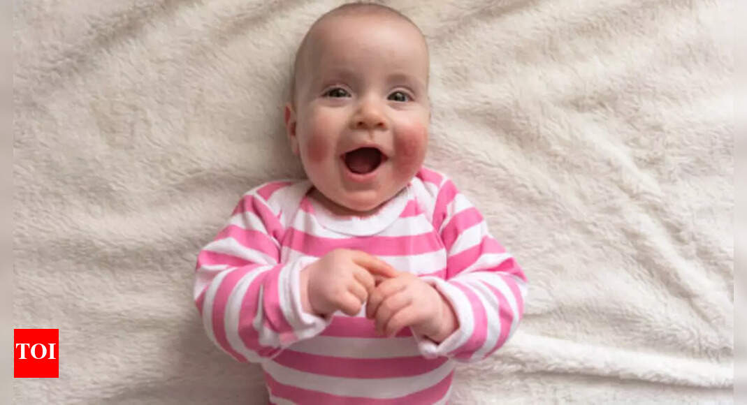 Gentle skincare solutions for babies with Eczema