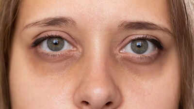 Dark circles under your eyes may reveal signs of kidney failure, liver disease, and more