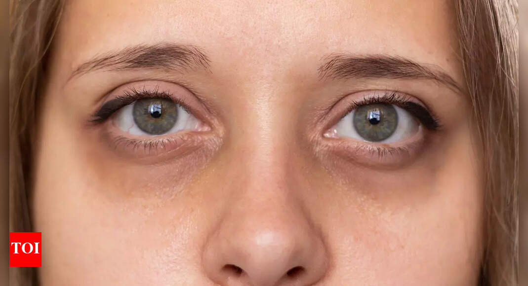 Dark circles under your eyes may reveal signs of kidney failure, liver disease, and more