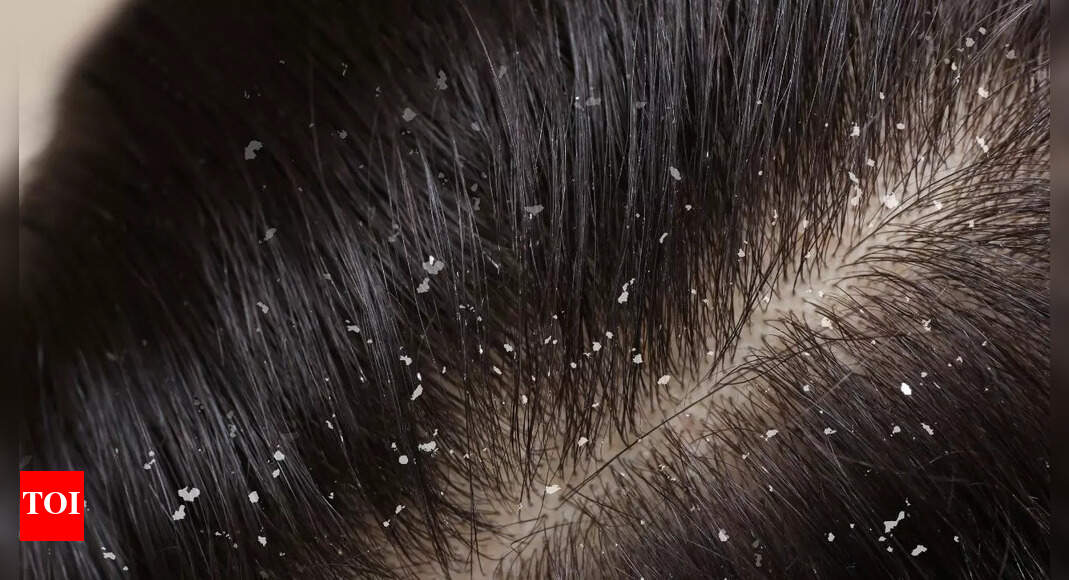 Does coconut oil increase dandruff: The truth about coconut oil and scalp health