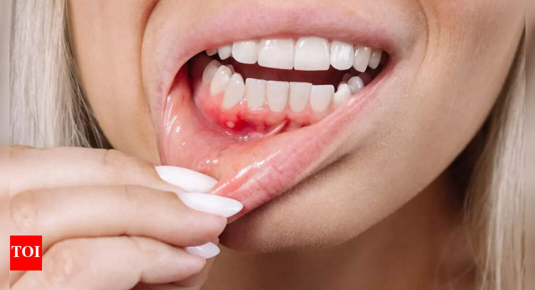 Persistent bleeding gums: Here are the diseases that could be causing it | – The Times of India