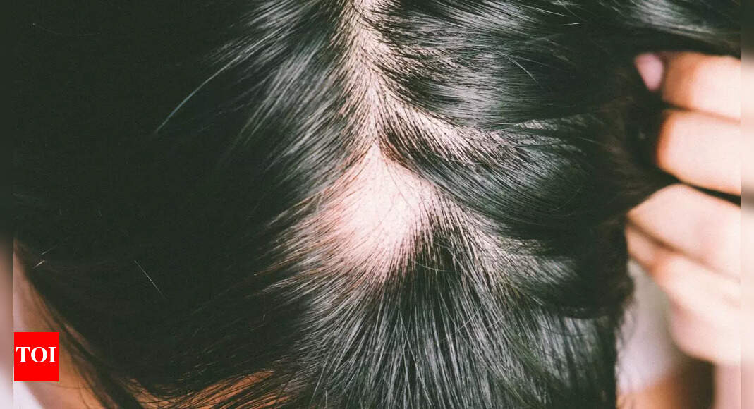 Diabetes is one of the major causes of hair loss: Understanding the effects, signs and symptoms