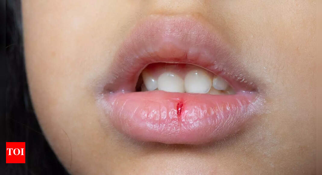 How to heal dry and chapped lips naturally: Signs, causes, and effective remedies