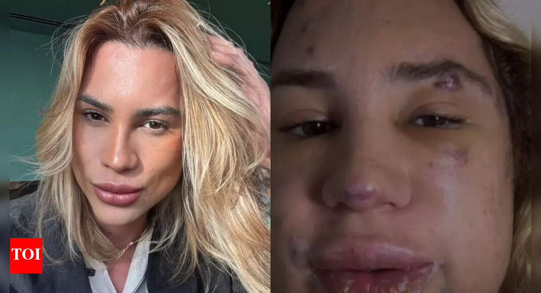 Brazilian influencer dies at 31: Succumbs to severe complications from cosmetic surgery