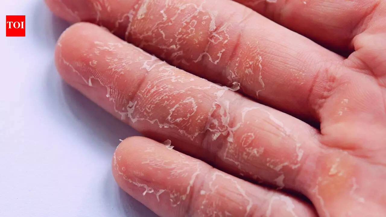 6 health issues behind dry, cracked fingertips and how to treat them ...