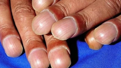 What is clubbing of nails, and why is it among the early indicators of liver disease