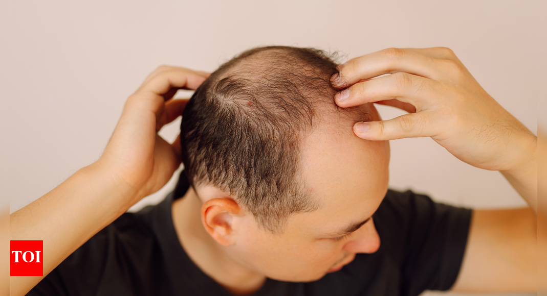 Balding (hair loss) is inherited from father's or mother's side? This is what Science says