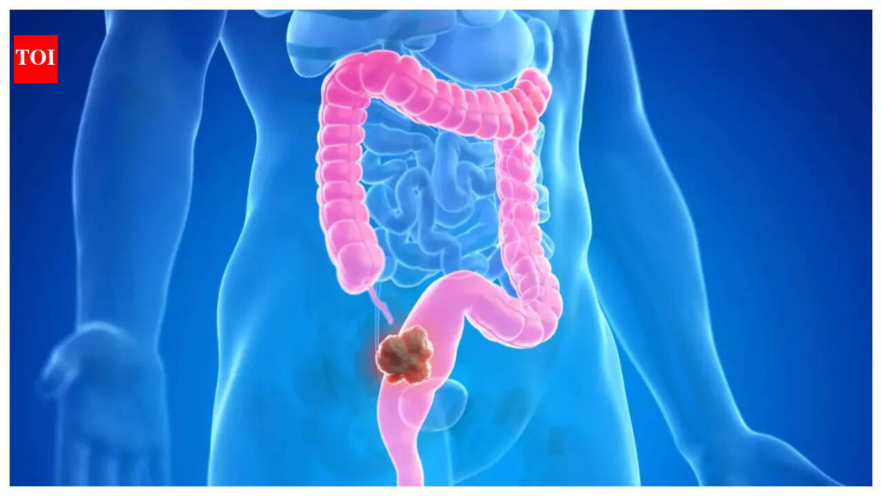 Colon Cancer: Harvard trained Gastroenterologist REVEALS 8 signs of ...