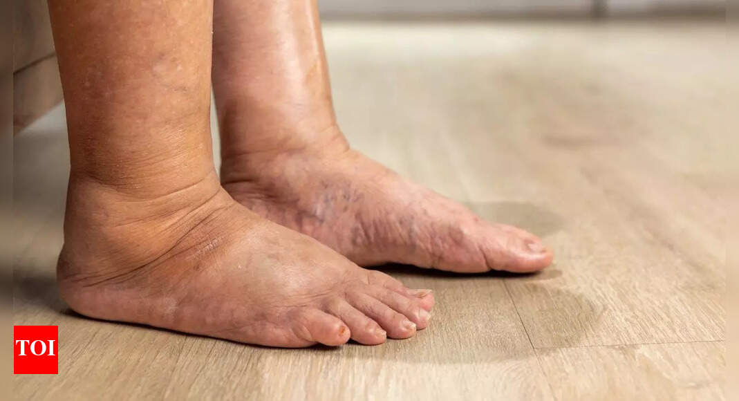 12 health-related causes of swollen ankles and how to reduce them