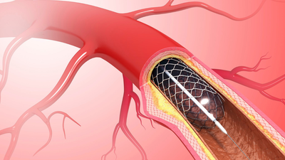 Peripheral Artery Disease: The surprising link between toe cramps and heart risk