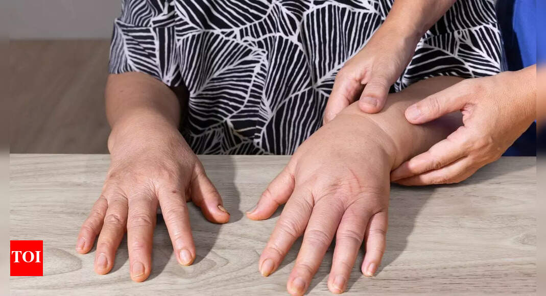 Why your hands swell: Common causes and treatment options for oedema