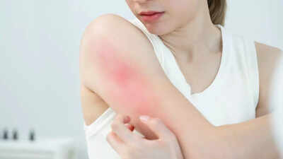 These skin problems could reveal hidden mental health risks, study finds