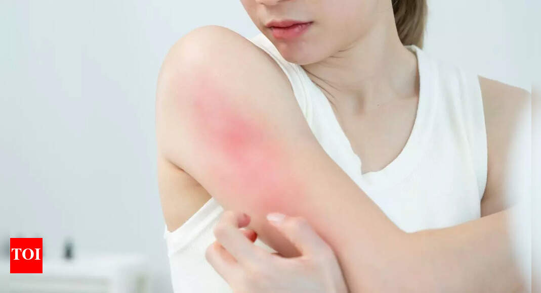 These skin problems could reveal hidden mental health risks, study finds |