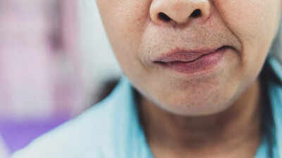 Facial paralysis warning signs: Key causes, symptoms, and prevention tips for sudden or gradual facial nerve damage