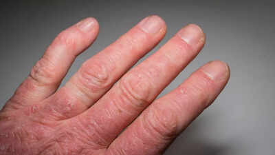 What is Psoriatic Arthritis: Know its signs, causes, and how to manage