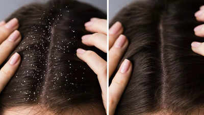 How to get rid of oily and sticky dandruff: 10 tips for a healthy scalp