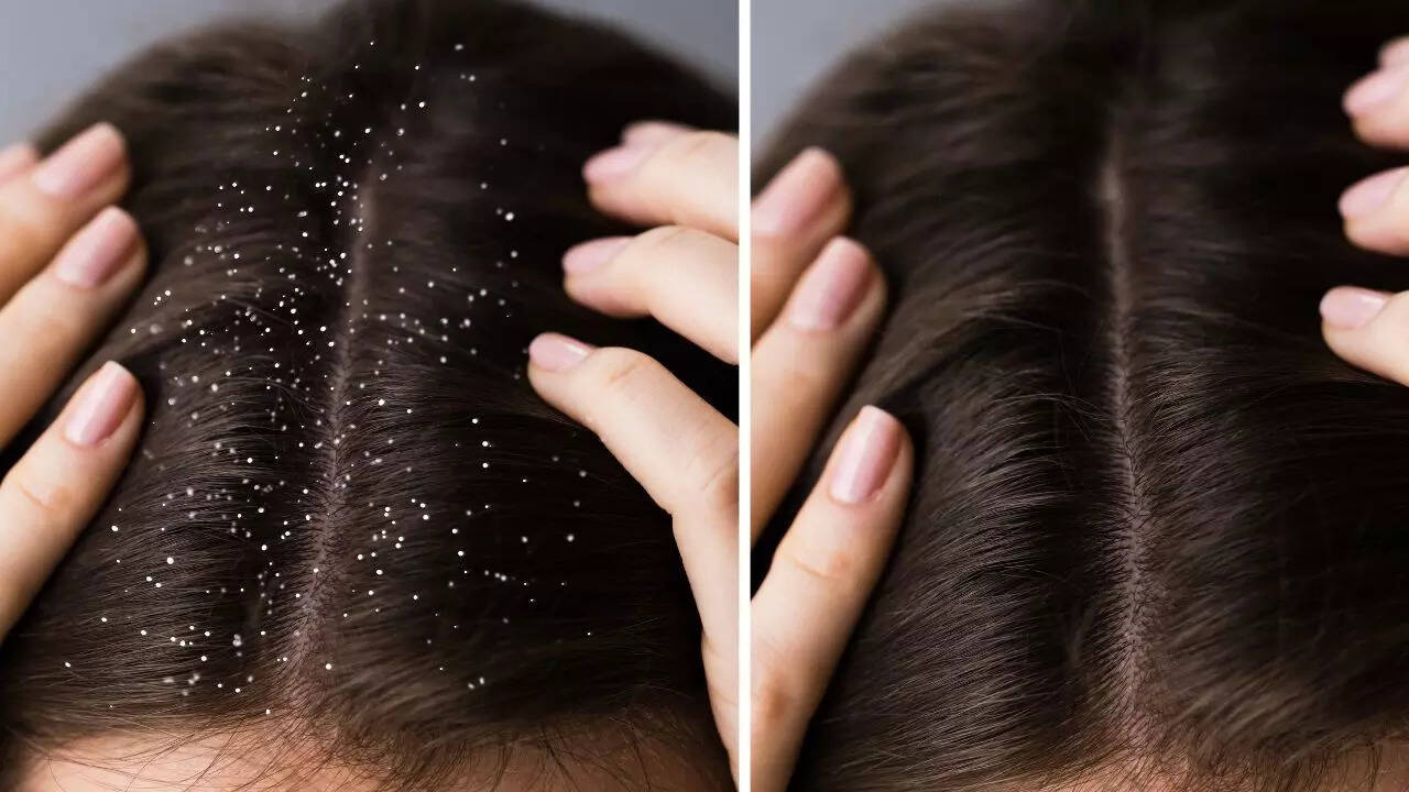 How to get rid of oily and sticky dandruff: 10 tips for a healthy scalp | -  The Times of India