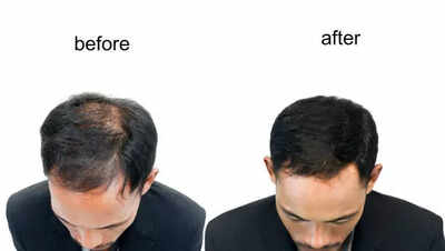 5 easy Indian home remedies to help reverse balding naturally