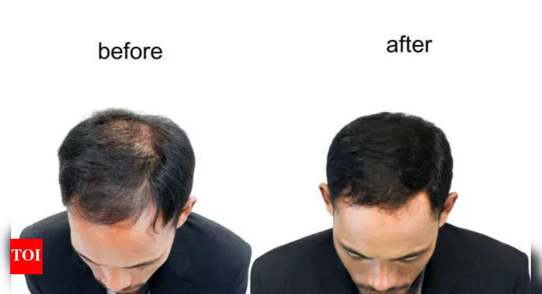 5 easy Indian home remedies to help reverse balding naturally