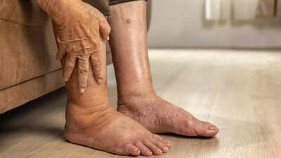 Pancreatic cancer: 4 warning signs in your legs that you shouldn't ignore |  - The Times of India