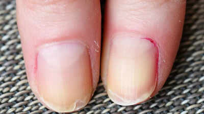 Why are your nails peeling: Know medical issues, causes, remedies, and prevention guide