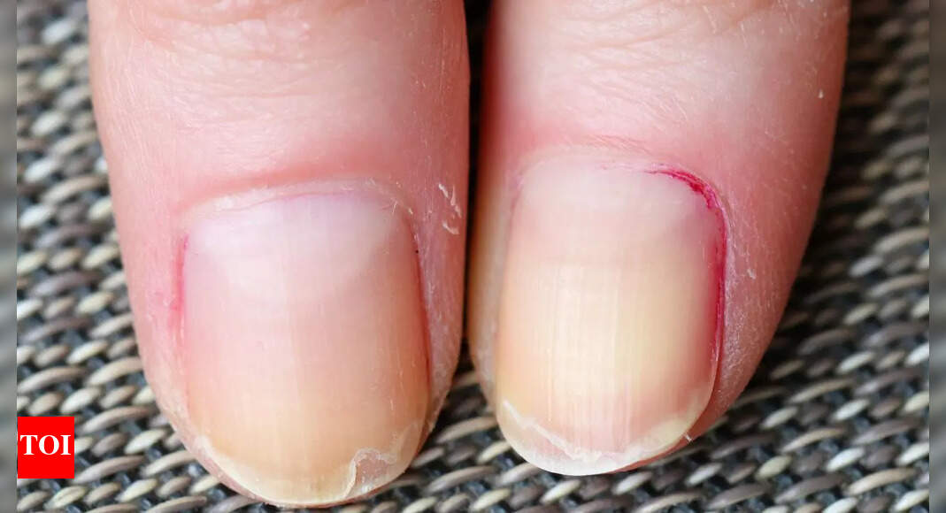 Why are your nails peeling: Know medical issues, causes, remedies, and prevention guide