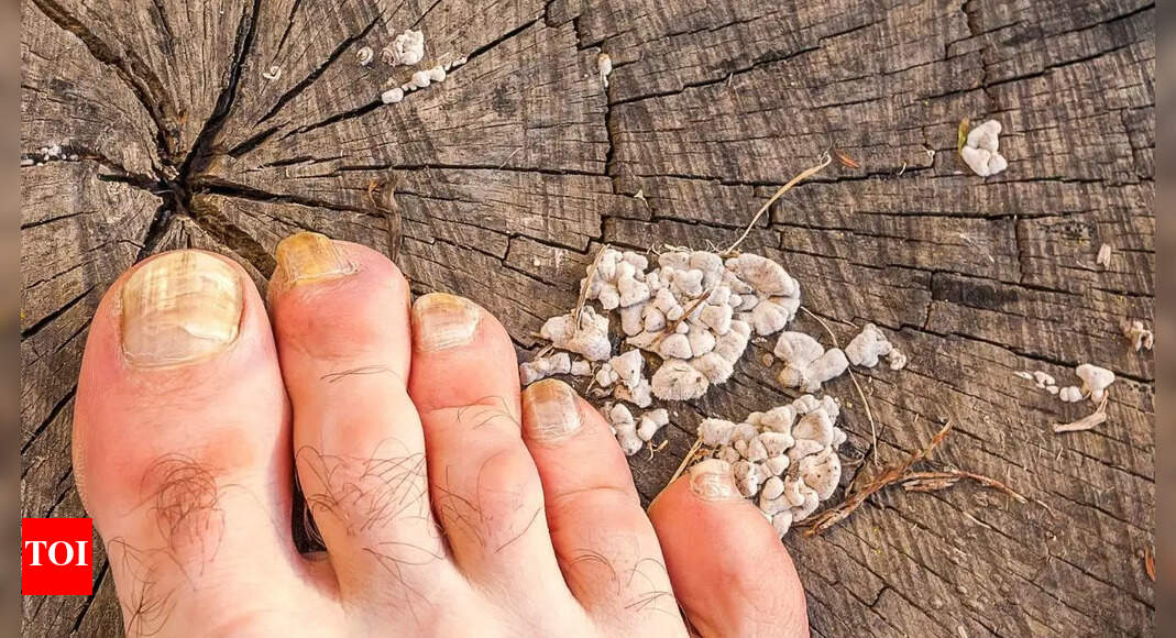 Fungal nail infection remedies: How to treat and prevent yellow and brittle toe nails naturally