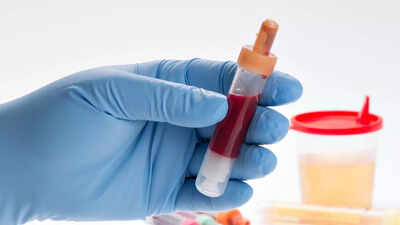Is blood in urine a sign of kidney cancer? Know the causes, signs, and risk factors