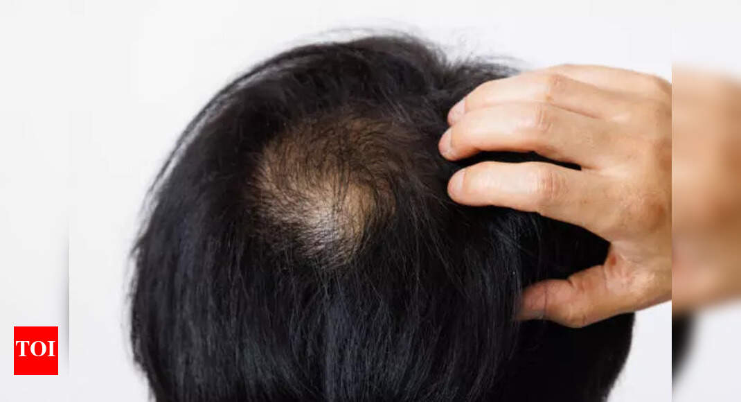 Explained: What is the correct way of massaging castor oil to regrow hair in bald patches