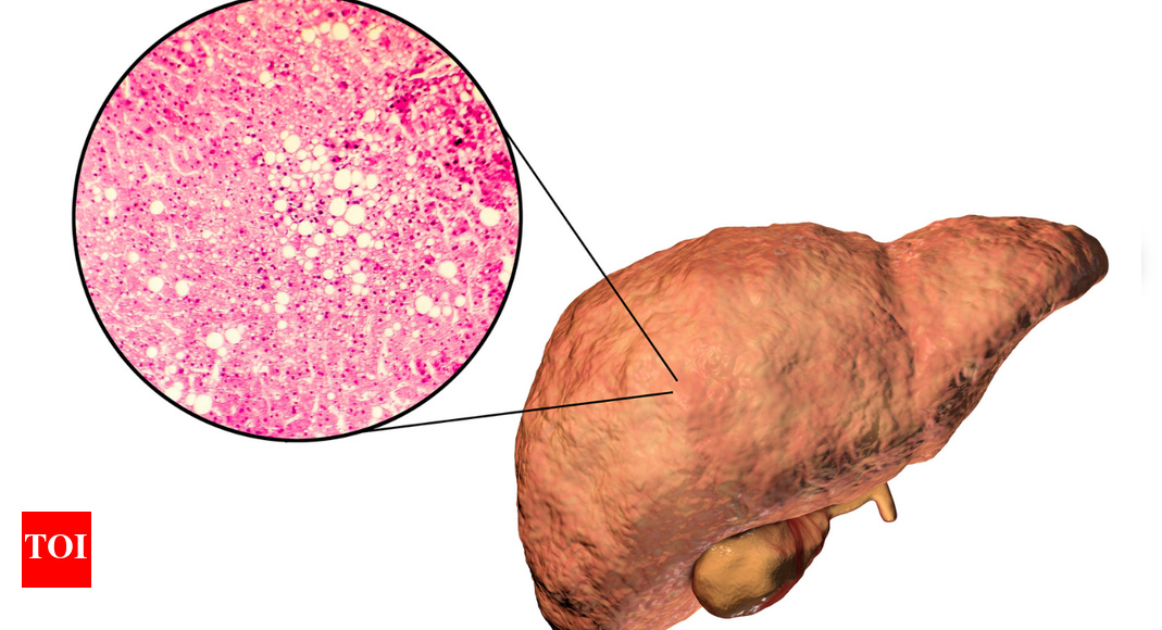 Non-alcoholic Fatty Liver Disease (NAFLD): What really causes it and how to fix it