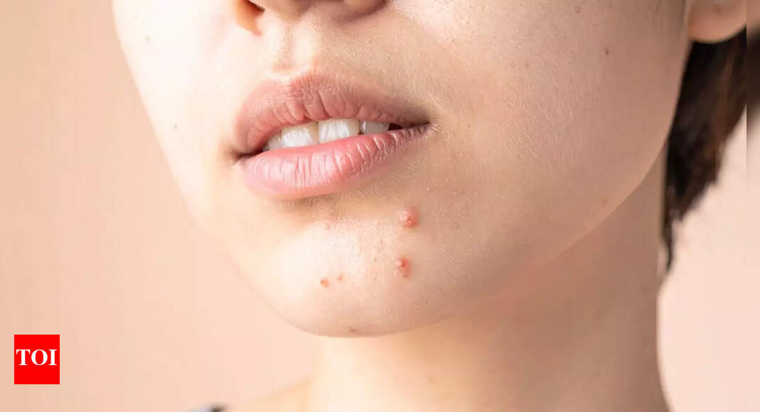 Acne scars treatment: How to remove them and post-acne care guide