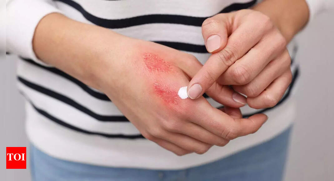 Quick recovery tips for hand burns from the viral Diwali sanitiser handshake trend