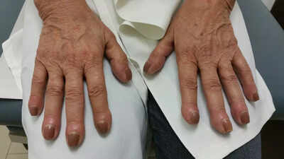 Lung cancer symptoms on fingers: Finger clubbing, nail changes and other warning signs that could indicate serious health risks